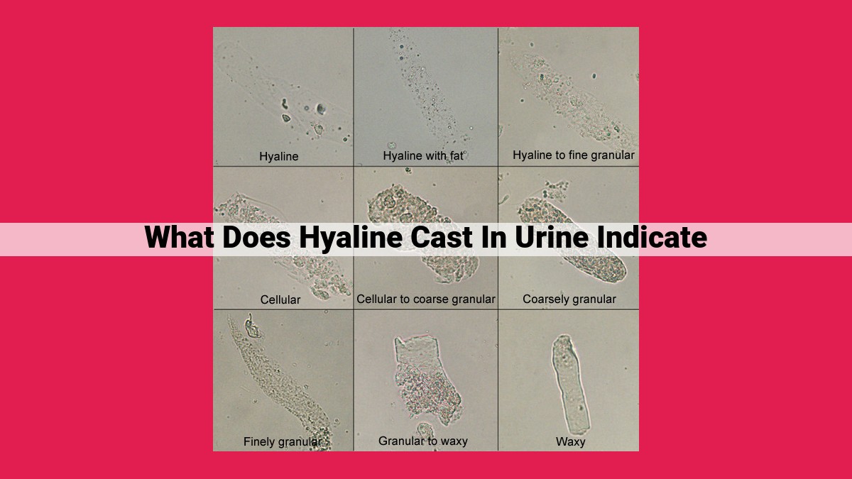 what does hyaline cast in urine indicate